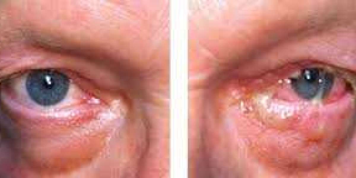 Azithromycin for Eye Infections & Conjunctivitis Care